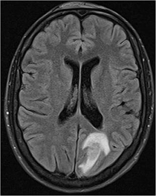 Autologous Stem Cell Transplantation in Common Variable Immunodeficiency: A Case of Successful Treatment of Severe Refractory Autoimmune Encephalitis